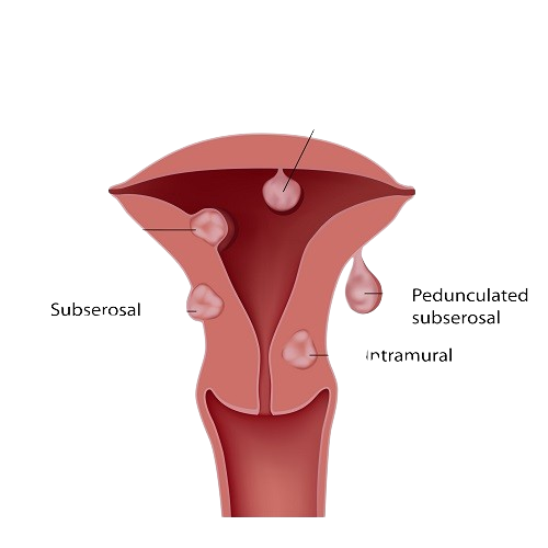 Uterine Fibroids